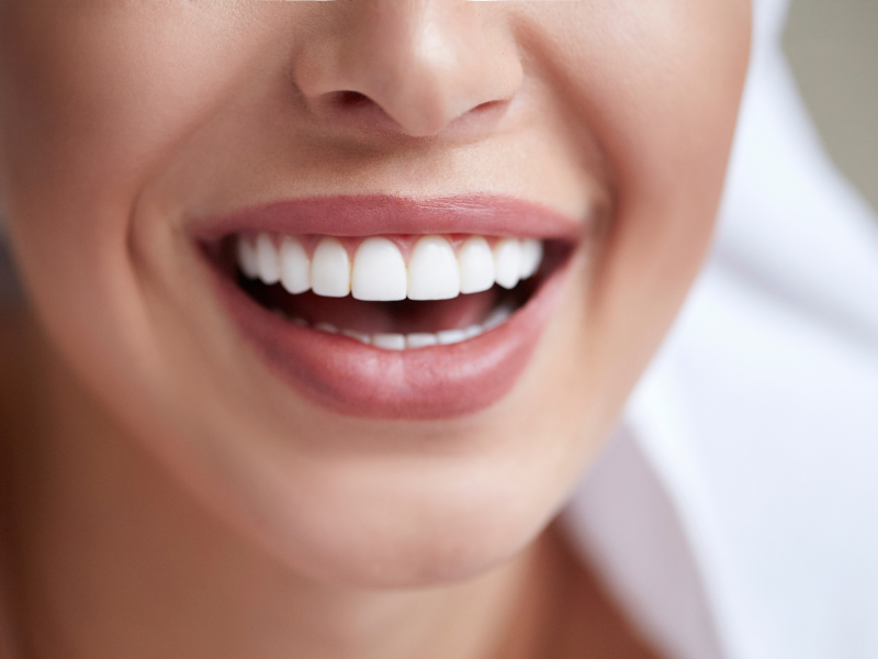 Branqueamento dentário: o que devo saber