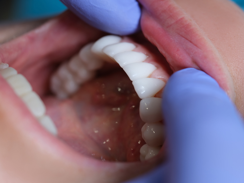 Doenças Periodontais