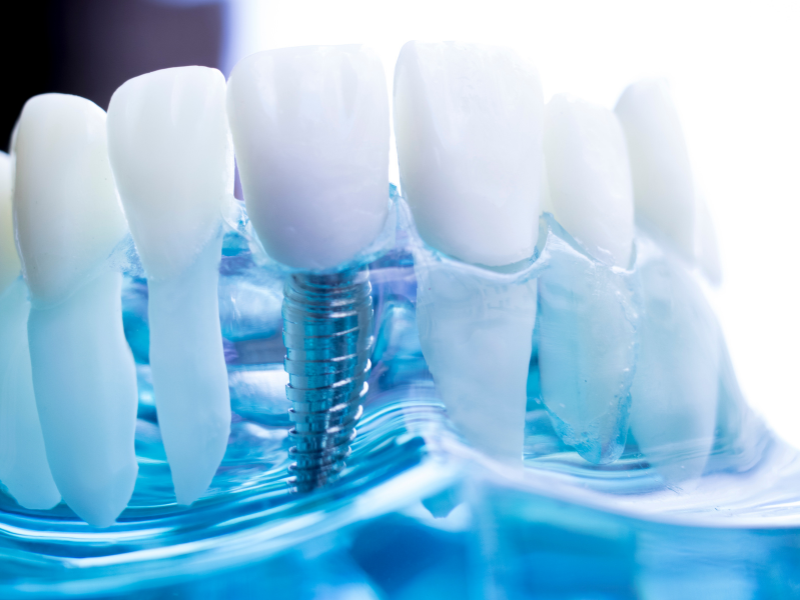 Quais as consequências da perda de dentes?